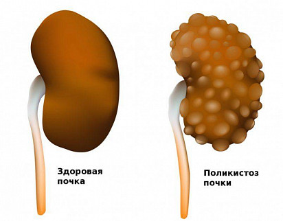 Поликистоз почек у кошек